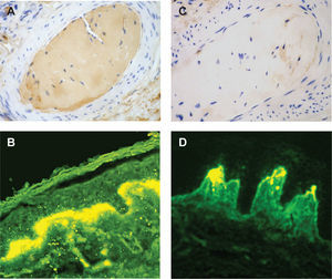 Estudios de immunoperoxidasa que muestran la tinción del material amorfo con anticuerpos de cadenas ligeras κ (A), pero no con cadenas ligeras λ (C). Estudios de inmunofluorescencia directa para IgM, donde se observa un marcado depósito lineal en la unión dermoepidérmica de la piel lesional (B) y un depósito discontinuo no lineal en la piel perilesional (D) (original amplificación ×40). IgM: inmunoglobulina M.