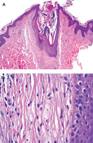 (A) Dilatación e hiperqueratosis en el infundíbulo folicular junto con un infiltrado perifolicular de macrófagos xantomizados. (Hematoxilina-eosina, ×40.) (B) Detalle donde se observa la naturaleza del infiltrado perinfundibular. (Hematoxilina-eosina, ×200.)