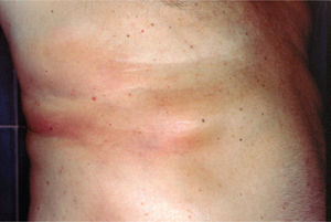 Placa eritemato-edematosa, mal delimitada, localizada en hemitórax derecho.