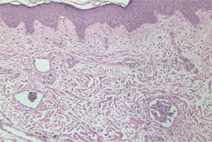 Infiltración de linfáticos dérmicos por células neoplásicas. (Hematoxilina-eosina, ×100.)
