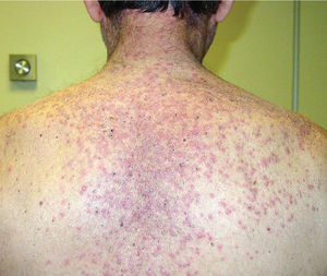 Lesiones papulopustulosas en la espalda.