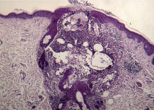 Imagen histológica de una papulopústula: foliculitis neutrofílica PAS (ácido periódico de Schiff) negativa. (PAS, ×25.)