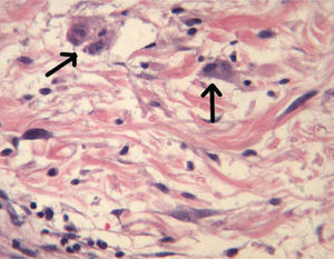 Histiocitos atípicos con binucleación (flechas). (Hematoxilina-eosina, ×200.)