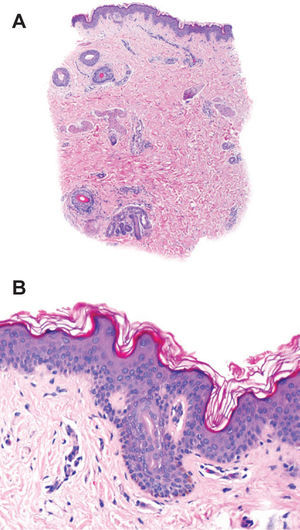 (A) Epidermis y dermis de apariencia normal. (B) Hiperpigmentación focal de la membrana basal. (Hematoxilina-eosina)