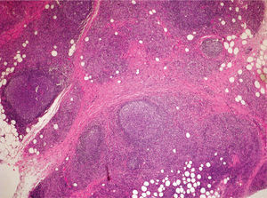 Folículos linfoides en el tejido celular subcutáneo separados por zonas de esclerosis (hematoxilina-eosina, ×10).