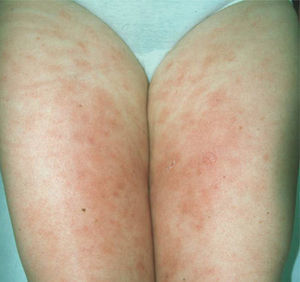 Áreas escleróticas eritematosas y edematosas en ambas piernas.