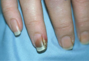 Lesiones necróticas en los dedos afectando al lecho ungueal.