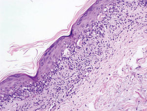 Hematoxilina-eosina, ×10. Hiperqueratosis con paraqueratosis focal en la capa córnea, acantosis, papilomatosis y exocitosis de células mononucleares. Cuerpos de Civatte en capas medias e inferiores de la epidermis y degeneración hidrópica de la capa basal. Infiltrado inflamatorio en banda formado principalmente por mononucleares en la dermis superior.