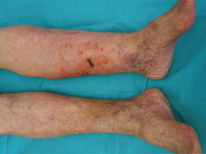 Signos de insuficiencia venosa crónica junto a asimetría y agregado papuloso traslúcido en pierna izquierda.