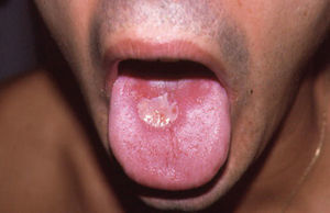 Placas eritemato-edematosas localizadas en la cara dorsal de la lengua.