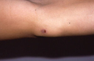 Placas eritemato-edematosas localizadas en extremidad superior.