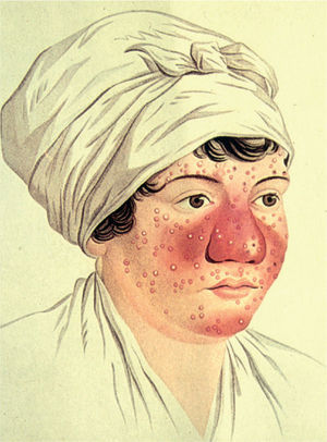 Ilustración clásica donde se representan los aspectos más característicos de la rosácea: eritema malar, pápulas y pústulas.