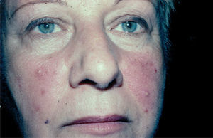 Rosácea eritemato-telangiectásica con mínimo componente papuloso.