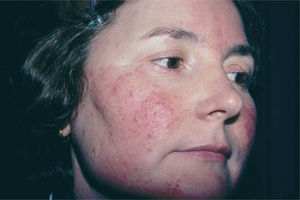 Rosácea pápulo-pustulosa leve.