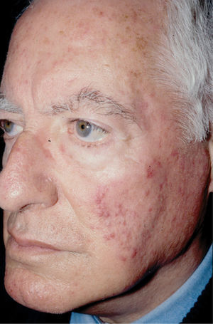 Rosácea pápulo-pustulosa grave antes del tratamiento.