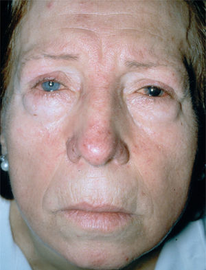 Rosácea ocular. Obsérvese la afectación conjuntival (blefaritis).