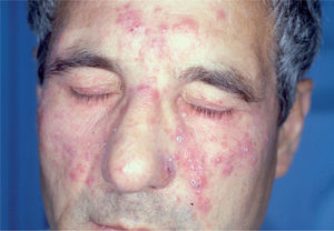 Rosácea pápulo-pustulosa grave antes del tratamiento con isotretinoína oral.