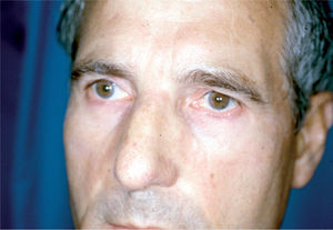 El mismo paciente de la figura 6 tras tratamiento.