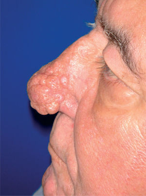 Rinofima antes del tratamiento quirúrgico.