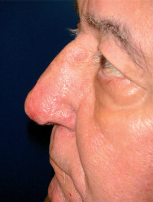 Paciente de la figura 8 tratado mediante electrocauterización con radiofrecuencia.