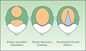 Patrones fenotípicos de alopecia femenina.
