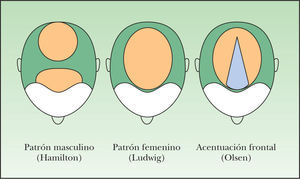 Patrones fenotípicos de alopecia femenina.