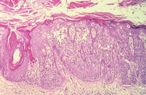 Múltiples células de epidermodisplasia verruciforme en una enfermedad de Bowen (hematoxilina-eosina ×100).