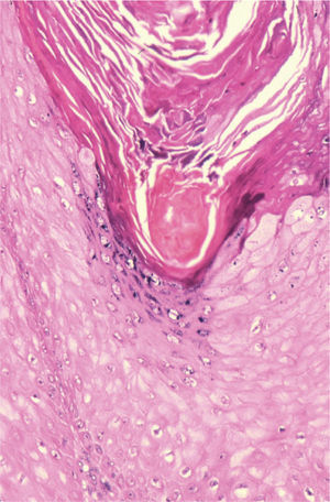 Nidos de células de epidermodisplasia verruciforme en un infundíbulo, junto a otros signos indirectos de infección por el VPH (hematoxilina-eosina ×200).