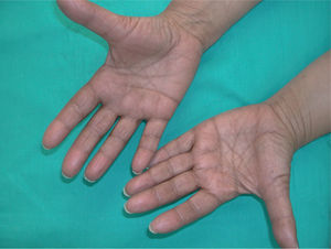 Eritema acral grado 1. Eritema sin molestias subjetivas.