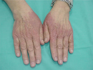 Lesiones extrapalmoplantares. Afectación del dorso de dedos y manos.
