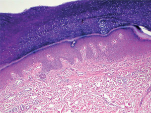 Eritema acral grado 1. Dilatación del plexo vascular en dermis papilar, áreas focales de degeneración hidrópica y necrosis aislada de queratinocitos. Hematoxilina-eosina, x40