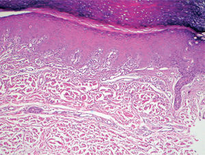 Eritema acral grado 2. Dilatación del plexo vascular en la dermis papilar y mayor grado de necrosis de queratinocitos. Hematoxilina-eosina, x40.