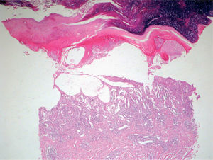 Eritema acral grado 3. Ampolla subepidérmica. Necrosis por coagulación de la epidermis e intensa dilatación vascular. Hematoxilina-eosina, x10.