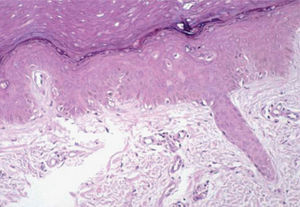 Siringometaplasia escamosa ecrina acompañada de necrosis de queratinocitos. Hematoxilina-eosina, x100.