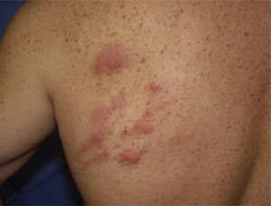 Lesiones nodulares violáceas agrupadas en el área escapular izquierda.