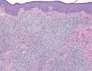 Infiltrado de células de aspecto polimorfo, tanto en su tamaño, intermedio y grande, como en su forma, apreciándose muchas células de morfología hendida y otras grandes no hendidas. Hematoxilina-eosina ×100.