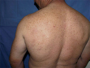 Área escapular con respuesta completa tras 4 ciclos de rituximab intralesional.