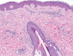 Biopsia tras la finalización del tratamiento sin evidencia de linfoma. Hematoxilina-eosina ×100.