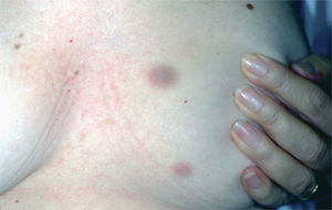Nodulos eritemato-violáceos, indurados, en mama izquierda.