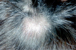 Nódulos eritemato-violáceos, indurados, en cuero cabelludo.