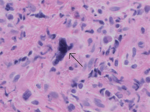 Hematoxilina-eosina ×400: detalle de un megacariocito (flecha negra).