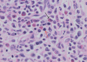 Hematoxilina-eosina × 400: detalle de los precursores mieloides (flecha roja) y eosinófilos (flecha negra).