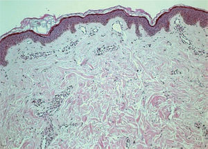 Hallazgos histopatológicos de eritema lívido, con vasos dilatados en la dermis papilar. Hematoxilina-eosina, ×40.