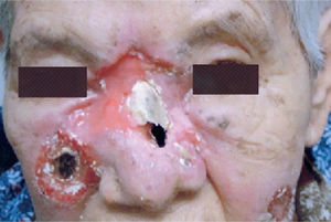 Neoformación indolora en vestíbulo nasal que fue aumentando de volumen hasta ulcerar la piel y se extendió hasta afectar la totalidad de la nariz y ambas regiones malares.