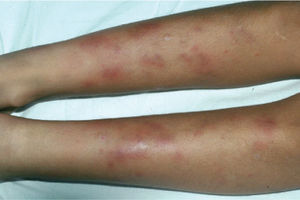 Eritema nodoso aparecido a los 16 días de tratamiento con griseofulvina en el caso número 2.