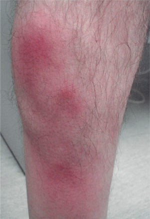 Imagen clínica del caso 8. Nódulos eritematosos de distribución lineal en la pierna derecha. El diagnóstico clínico inicial fue de eritema nodoso. Este paciente presentaba como antecedente una enfermedad de Buerger.