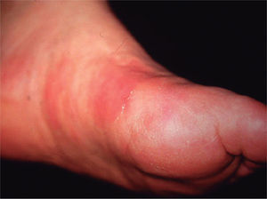 Imagen clínica del caso 3. Placas eritematosas calientes en el pie izquierdo. El paciente fue diagnosticado inicialmente de celulitis sin respuesta al tratamiento con diversos antibióticos.