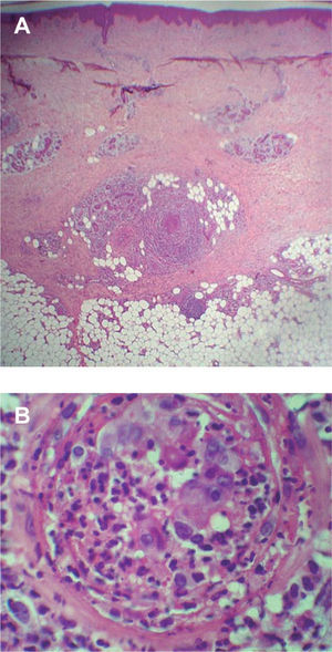 Imagen histológica del caso 7. A) Afectación de una vena de gran tamaño localizada en el tejido celular subcutáneo superficial (hematoxilina-eosina, ×40). B) Infiltrado inflamatorio con neutrófilos, eosinófilos e histiocitos que afectan a toda la pared vascular con oclusión de la luz (hematoxilina-eosina, ×400).