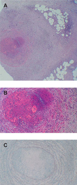 Imagen histológica del caso 8. A) Vena de gran tamaño en el tejido celular subcutáneo superficial con inflamación que se extiende hacia la grasa circundante compuesta por histiocitos y células gigantes (hematoxilina-eosina, ×100). B) Trombo organizado ocluyendo la luz vascular (hematoxilina-eosina, ×200). C) Tinción con orceína que muestra la ausencia de la lámina elástica interna (hematoxilina-eosina, ×200).