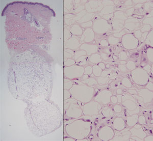 Atrofia parcial del tejido graso con adipocitos de pequeño tamaño entremezclados con otros de tamaño normal. De forma parcheada en el intersticio se observan escasos restos de un material hialino eosinófilo (hematoxilina-eosina, ×200).